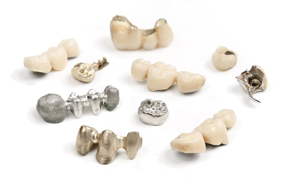 couronnes-dentaires-metal-ceramique-porcelaine-dentalam france