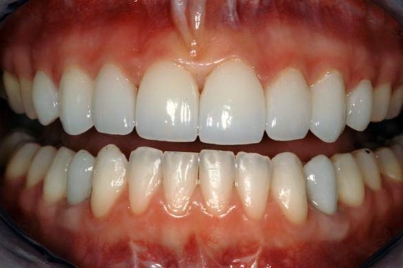 dents-sensibles dentalam dentiste france