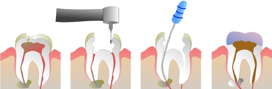dévitalisation dentalam dentiste france