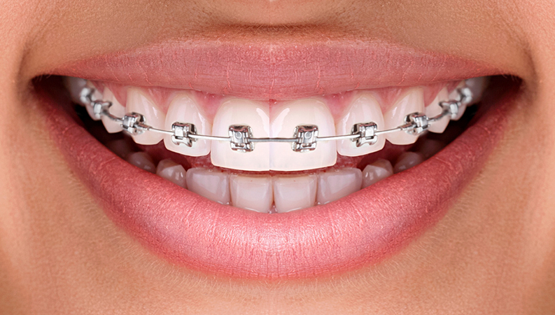 orthodontie adulte dentalam france