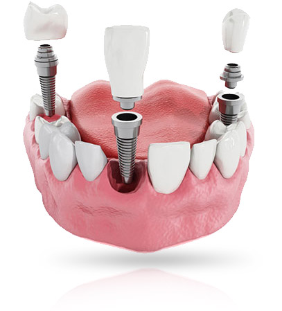 implante-dentalam-dentiste-france