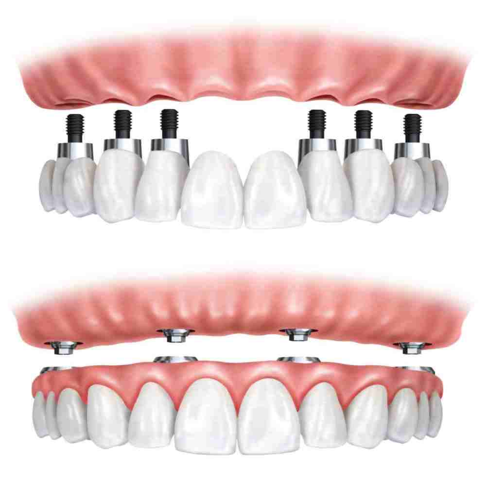 implant dentaire cabinet dentalam france
